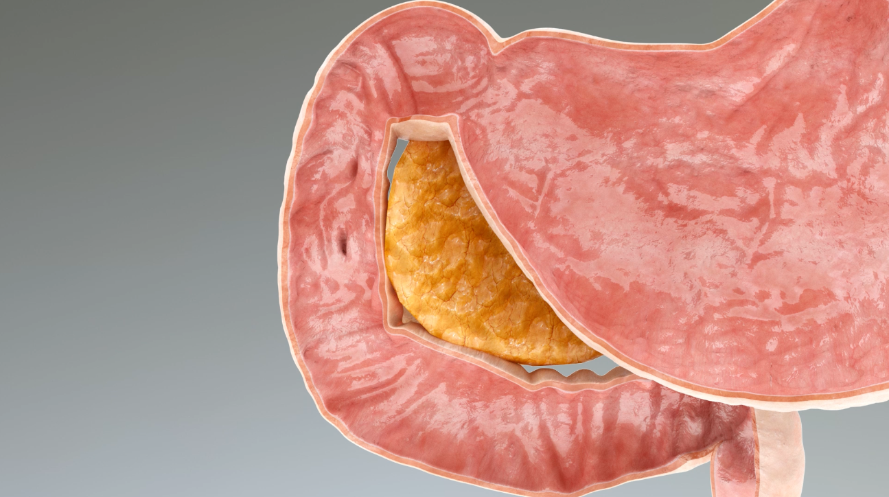 RF Vapor Ablation Aqua Medical
